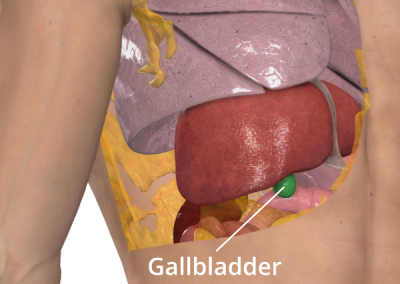 Illustration of the gallbladder poistion in the abdomen as aprt of the explanation of the Sugarbaker technique. Image courtesy of 3D4Medical.