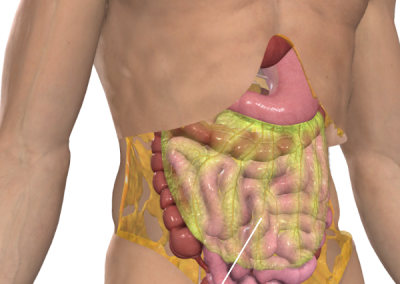 Illustration of the greater omentum which may be removed as part of the Sugarbaker technique. Image courtesy 3D4Medical
