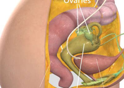 Illustration showing the uterus and ovaries as part of the Sugarbaker technique. Image courtesy of 3D4Medical, with permissions.