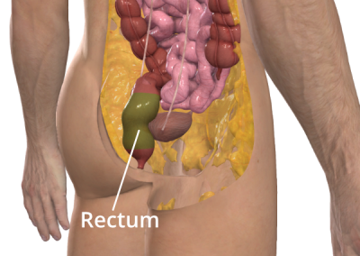 Illustration of the location of the rectum as part of the Sugarbaker technique. Image courtesy of 3D4Medical