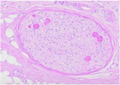 Slide of a goblet cell adenocarcinoma