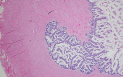 The Biology of pseudomyxoma peritonei (PMP)