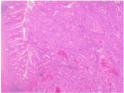 Slide of appendiceal adenocarcinoma. This lesion looks like a typical colorectal adenocarcinoma in terms of its appearance.