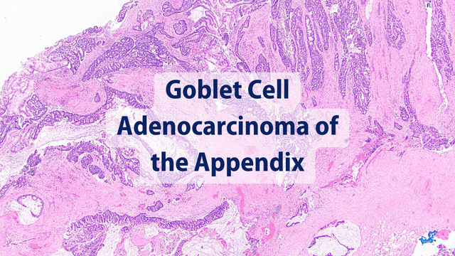 How are goblet cell adenocarcinomas treated?